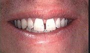 Porcelain Veneers