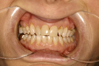 Gumline notches