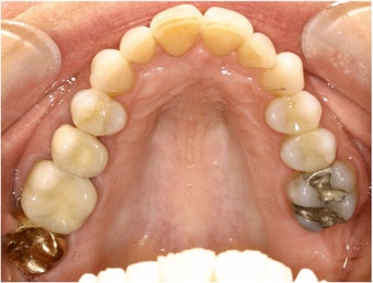Natural All Porcelain Restorations