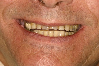 Full Smile Makeover