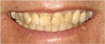 Porcelain Veneers