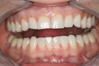 Whitening and Bonding