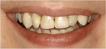 8 Veneers to a more confident smile