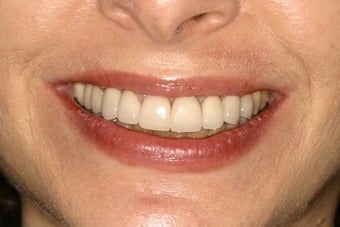 Tetracycline Stains treated with Veneers