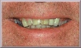 Porcelain Veneers