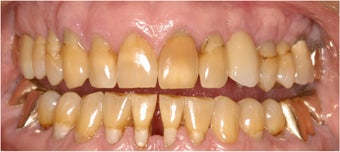 Closing black triangles between teeth