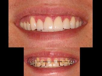 Whitening and porcelain veneers