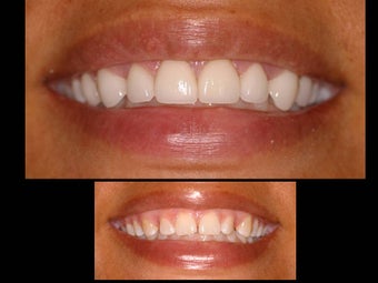Porcelain veneers to close gaps