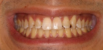 DURAthin minimal preparation porcelain veneers
