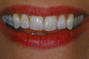 Porcelain Veneers