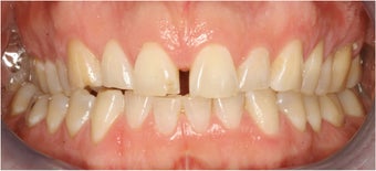 Closing Gap With Porcelain Veneers