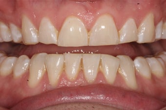 Prepless Veneers