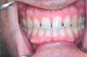Porcelain veneers