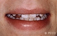 Porcelain Veneers