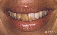 porcelain veneers