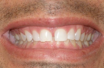 Veneers