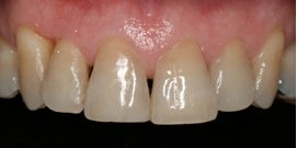 Veneers
