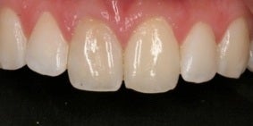 Minimal-Prep Veneers