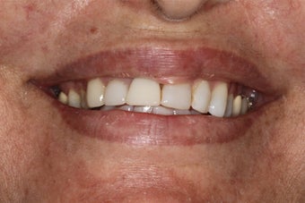 Porcelain Bridge and Veneers