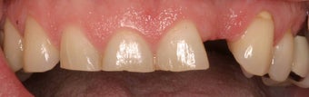 Porcelain Veneers and Crowns