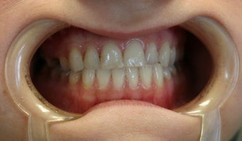 Upper arch make over with veneers and crowns