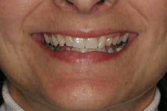 Smile Makeover with Minimal-Prep Porcelain Veneers