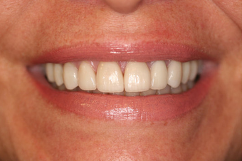  Porcelain Veneers Smile Makeover