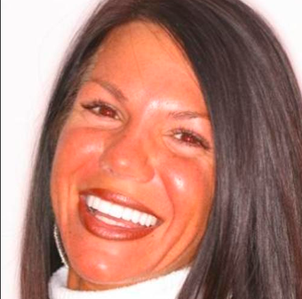 Porcelain veneers
