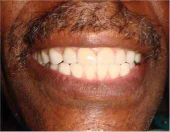 Veneers