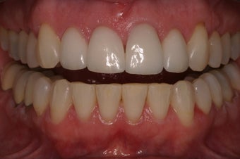 Veneers