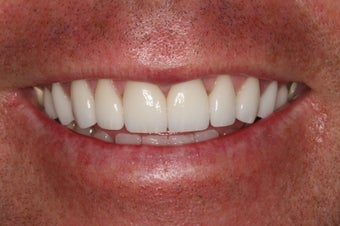 Porcelain Veneers/ Smile Makeover