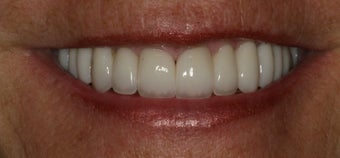 Smile Makeover