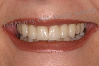 Smile Makeover with Porelain Veneers and Crowns