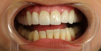 porcelain veneers