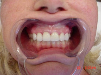 porcelain veneers
