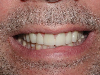 Porcelain Veneers