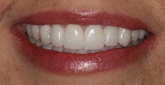 Porcelain Veneers
