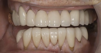 parcelain crowns and veneers