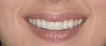 porcelain veneers