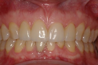 Porcelain Veneers four front teeth