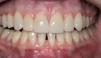 Replacement Porcelain Veneers