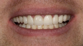 Porcelain Bridge and Veneer