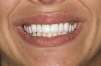 Veneers