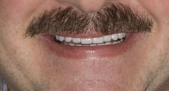 Porcelain Crowns and Veneer