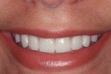  Porcelain Veneers