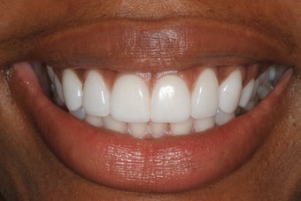Prepless Veneers