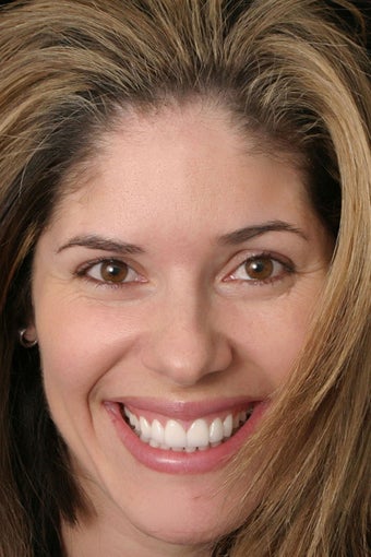 Eight porcelain veneers on upper teeth closing midline space.
