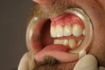 porcelain bridge with veneers replacing teeth