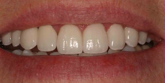 Porcelain Veneers and Crowns