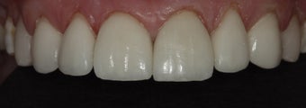 Porcelain Veneers and Crowns